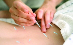 Acupuncture