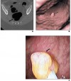 Colon polyps