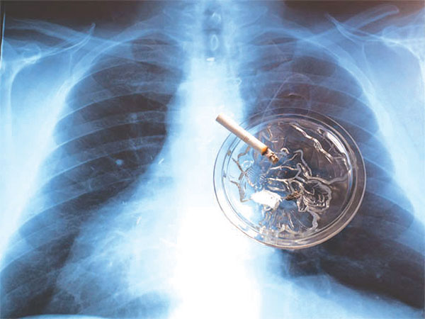 New type of CT scan may allow doctors to detect lung ...