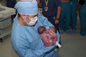 Mother holds conjoined twins for the first time 