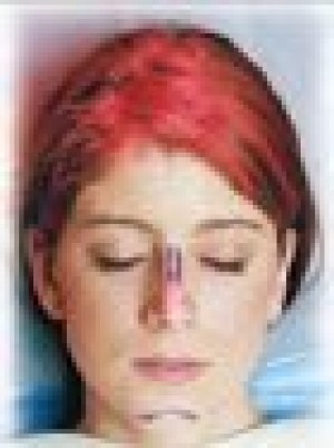 More adolescents turn to cosmetic surgery to increase confidence 