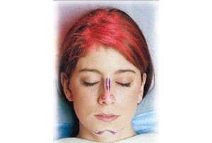 More adolescents turn to cosmetic surgery to increase confidence 