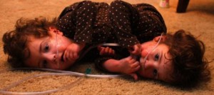 Conjoined twins face heart separation 