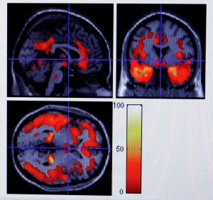 Computers closing in on Alzheimer's diagnosis 