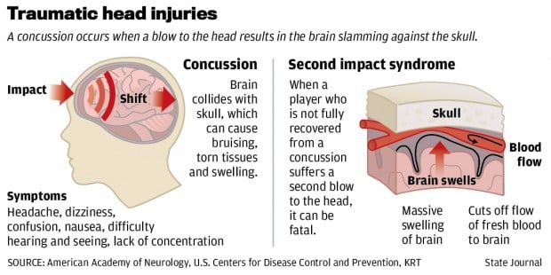 temporary amnesia from concussion