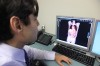 Melanoma