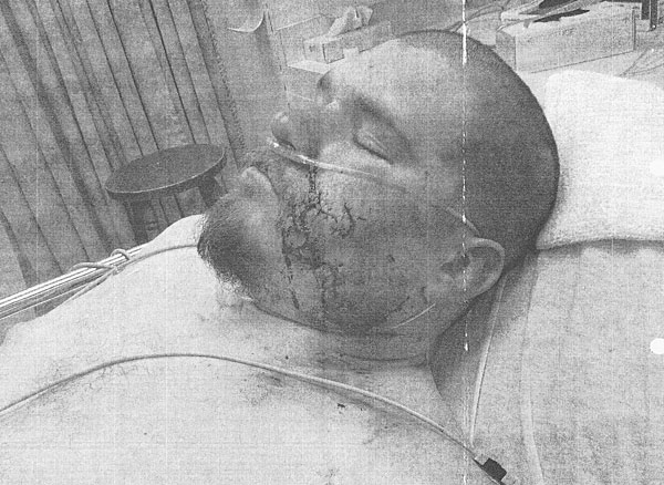 Man bit in face by Lodi police dog files suit against city, six officers