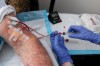 Dialysis