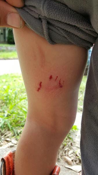 Boy attacked by pit bull