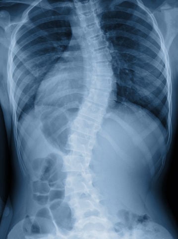 scoliosis stockimage