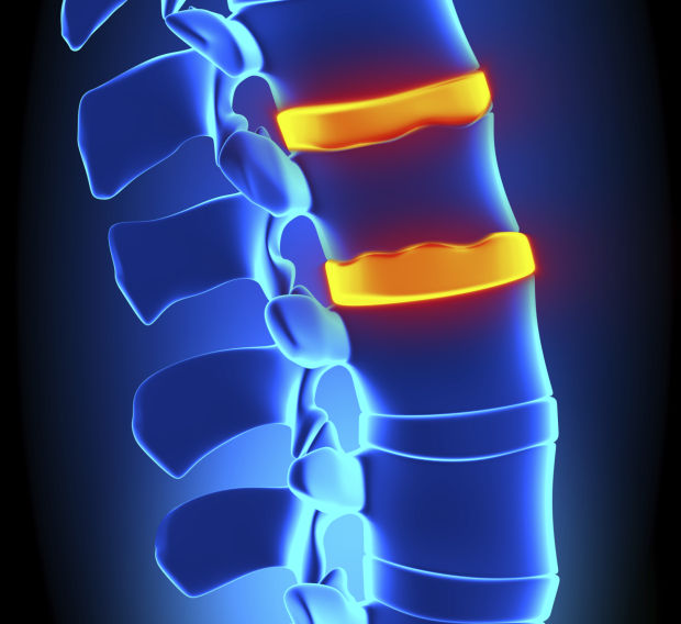 Spinal fusion improves quality of life for victims of trauma, arthritis and pain