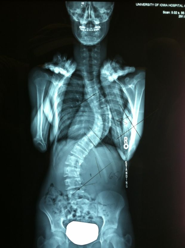 Mally Obenauf spine, curved