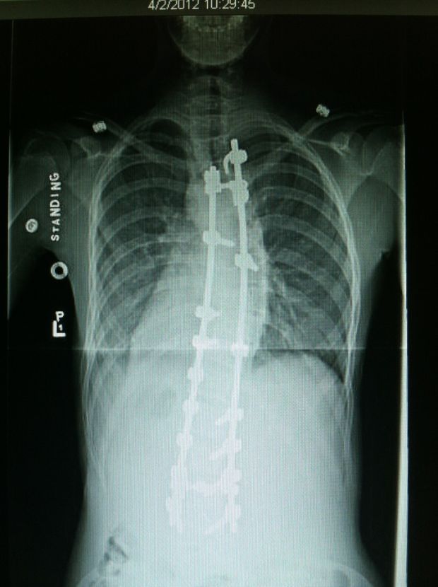 Mallory Obenauf spine, straightened