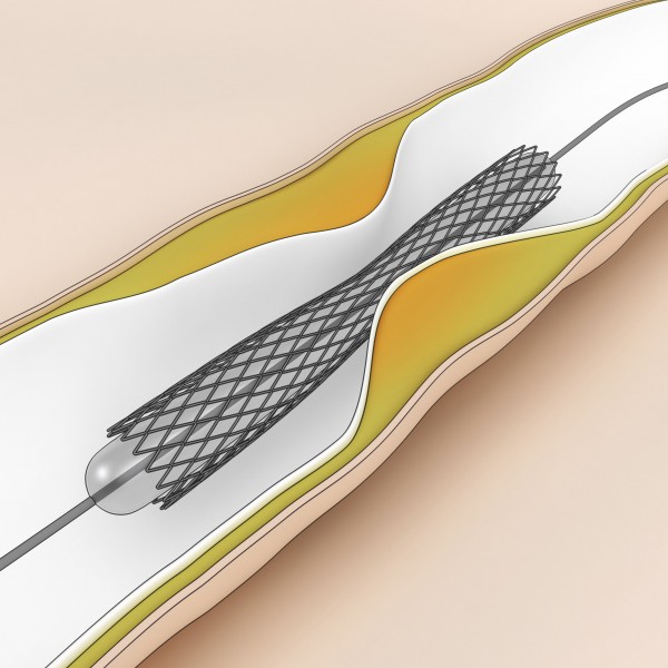 Heart savers: Stents continue to evolve | Health, Medicine and Fitness