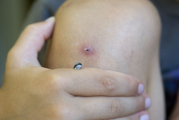 Snail Wound