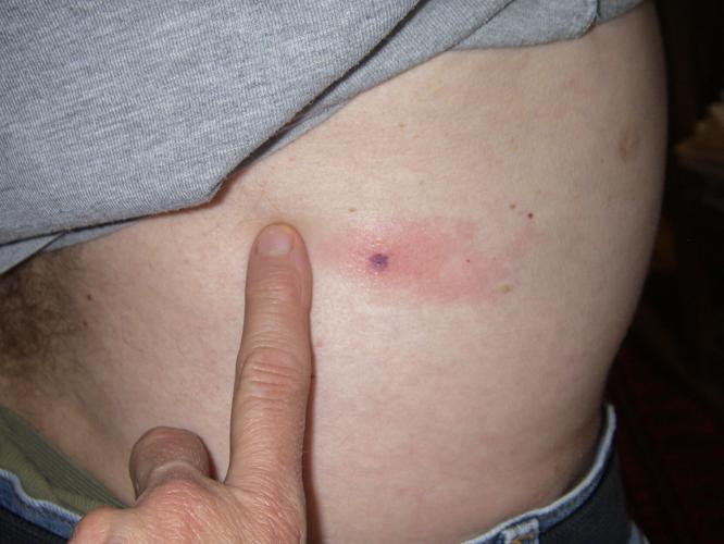 Tick bite