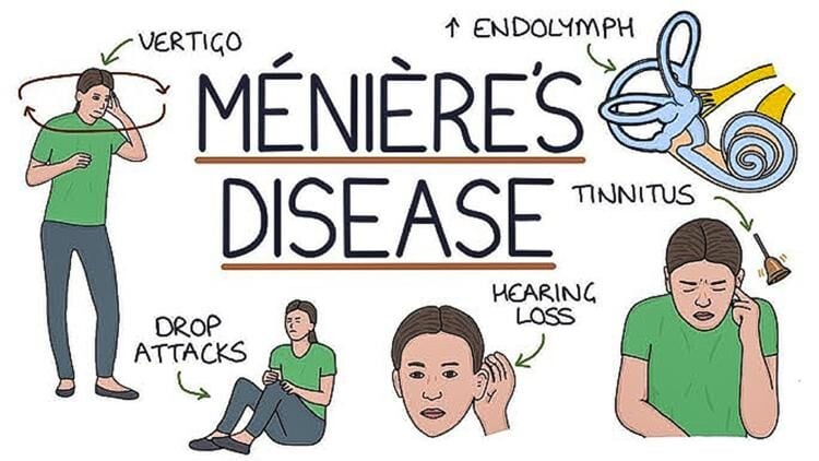 Ménière’s Disease symptoms