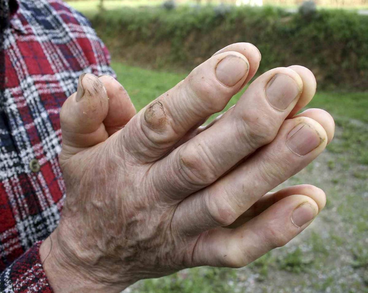 Farmers' hands with arthritis