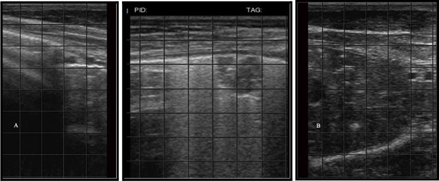 Lung ultrasound