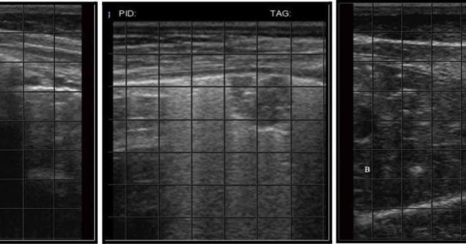 Lung ultrasound