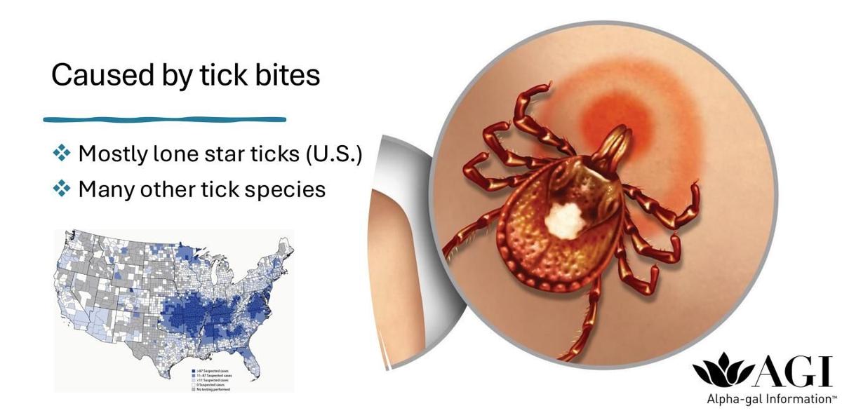 Alpha-gal Syndrome spread