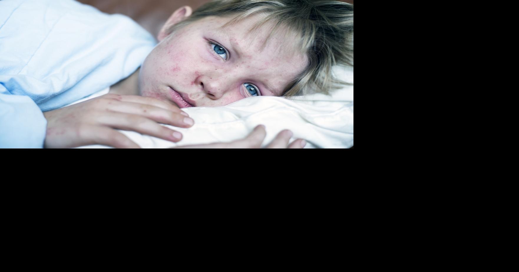 Answering patient questions about the measles