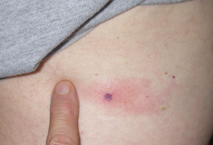 Tick bite