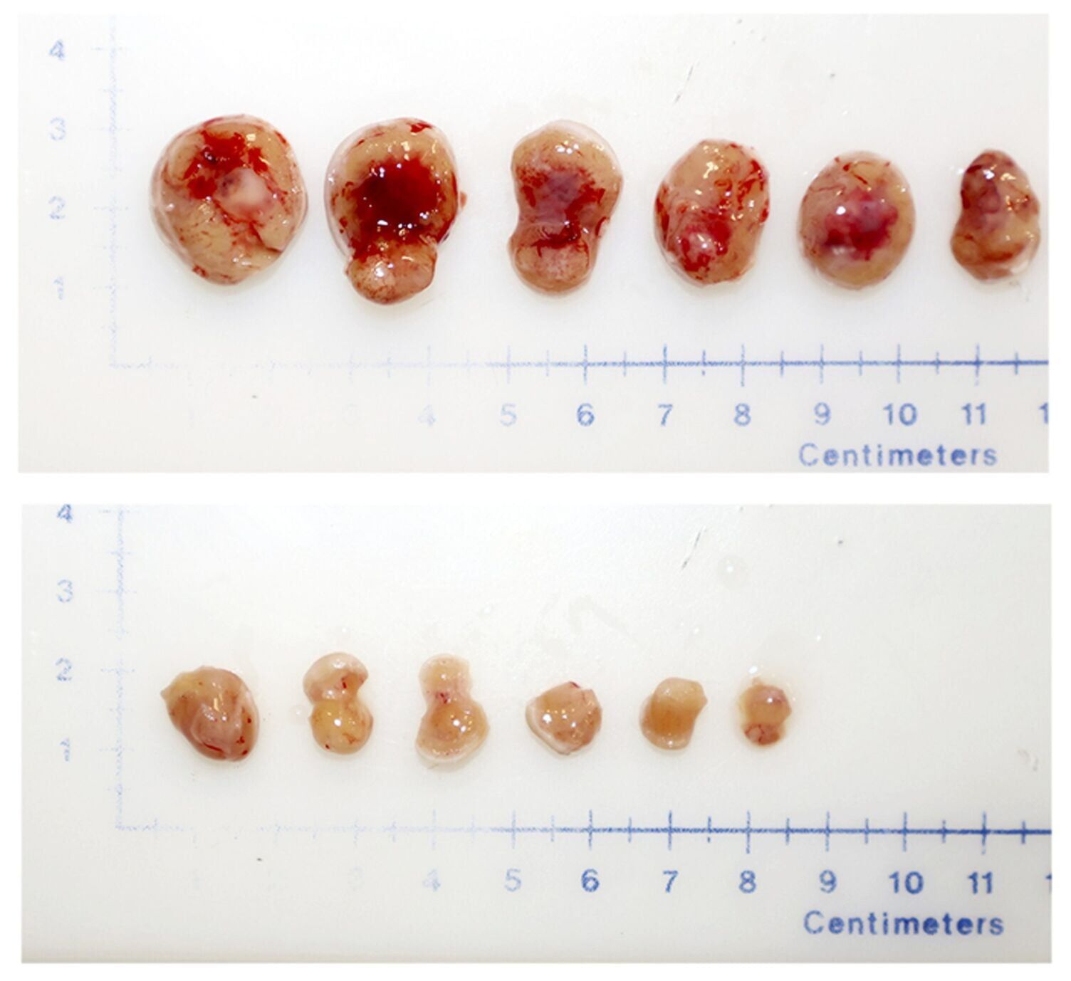 Columbia scientists find gene that drives prostate cancer