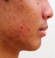 Image before and after acne treatment on the face of young Asian men. Problem skin and beauty concept.