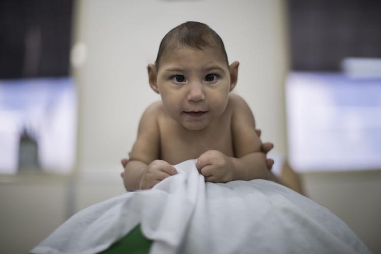 Brazil Zika Babies