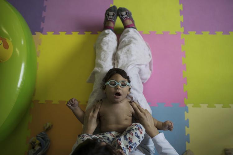 Brazil Zika Babies