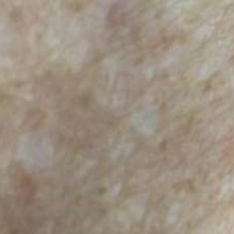 Can You Contract Lyme Disease In Nebraska Local Beatricedailysun Com