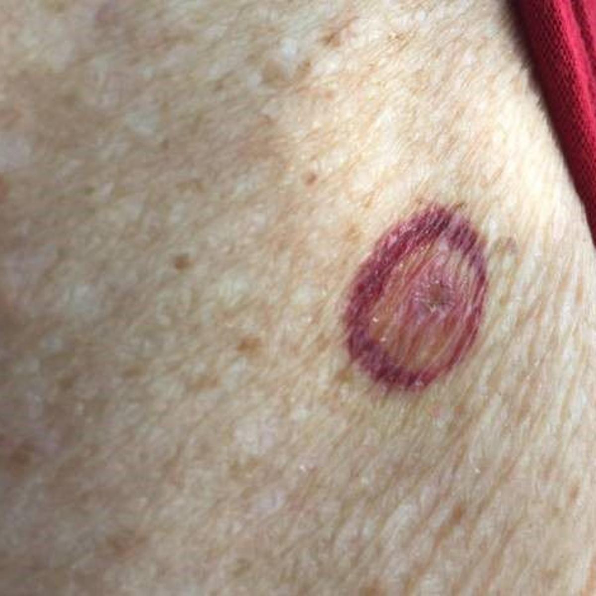 Can You Contract Lyme Disease In Nebraska Local Beatricedailysun Com Can You Contract Lyme Disease In Nebraska Local Beatricedailysun Com