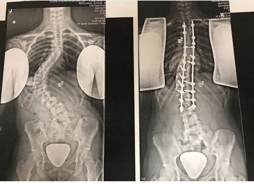 Teen hosts volleyball tournament for scoliosis News