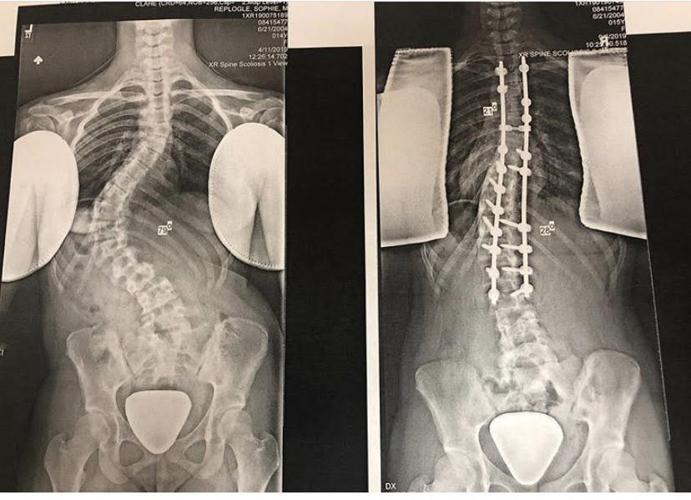 Teen hosts volleyball tournament for scoliosis News