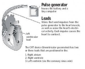 From the heart: Improving heart function with a pacemaker