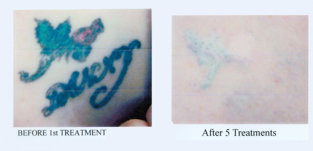 Tattoo removal helps former inmate start anew