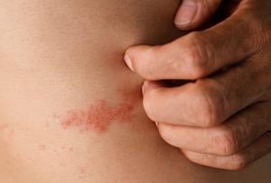 What to do if you have — or suspect you have — shingles