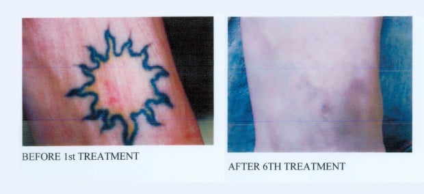 THE BEST 10 Tattoo Removal in Billings MT  Last Updated August 2023  Yelp