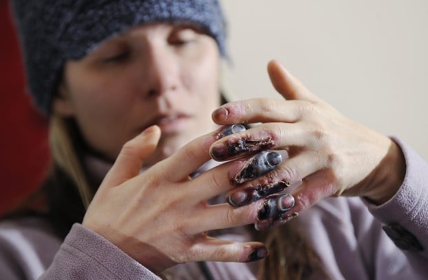 Injured ice climber recuperating: String of bad luck haunts Billings