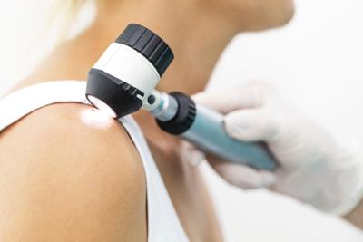 Doctor examining melanoma