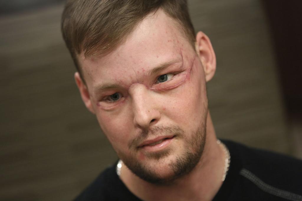Wyoming Man Receives Successful Face Transplant Wyoming News Billingsgazette Com