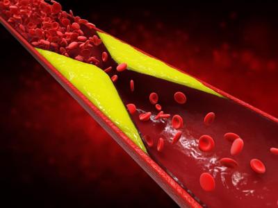 About 1 in 10 U.S. Adults Have High Cholesterol