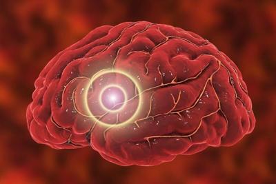 Higher Stroke Risk Among Children of Divorce