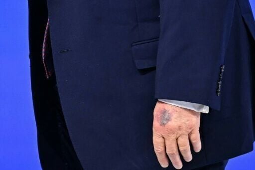 Fresh bruising could be seen on the back of US President Donald Trump's left hand during an event in Davos, Switzerland