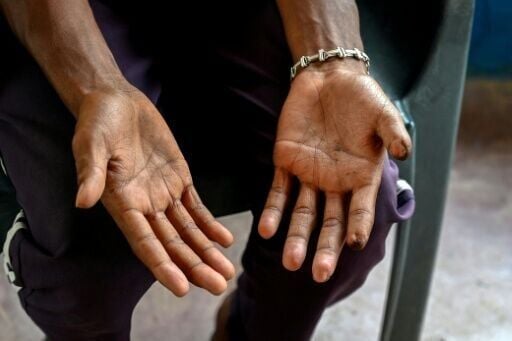 The maimed hands of mine victim Pramod Kakem at Narpali village