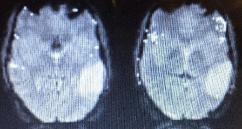 SWNS_TUMOUR_ANXIETY_001_134392