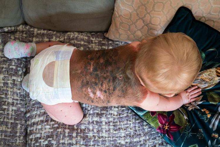 Family’s plea as baby’s ultra-rare birthmark tests as cancerous