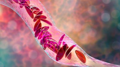 Premature Aging in Brains of Sickle Cell Patients