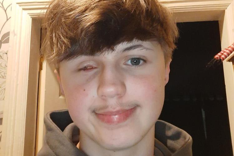 Teenager, 17, lost eye after ‘dud’ firework exploded in his face